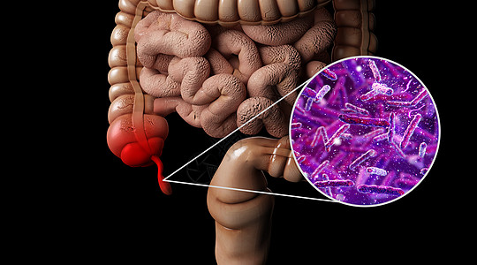 梗塞人体阑尾炎场景设计图片