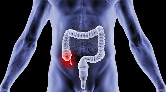 急性咽炎人体阑尾炎场景设计图片