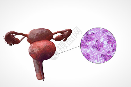 阴道疾病阴道细菌感染设计图片