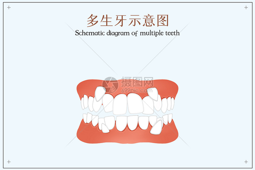 多生牙示意图口腔医学插图图片