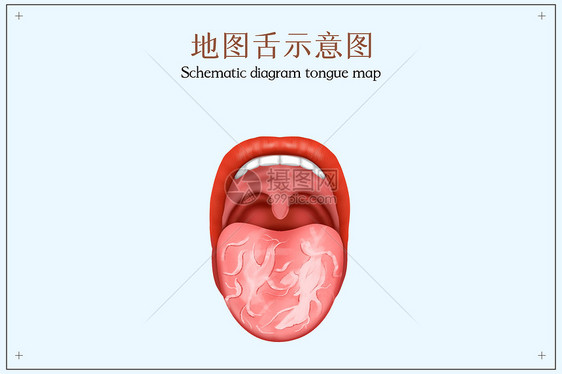 地图舌示口腔医学配图图片