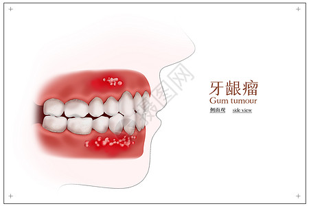 牙龈瘤口腔医学配图高清图片