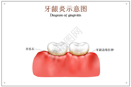 发炎牙龈炎口腔医学配图插画