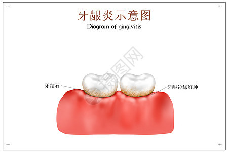 牙龈炎口腔医学配图图片