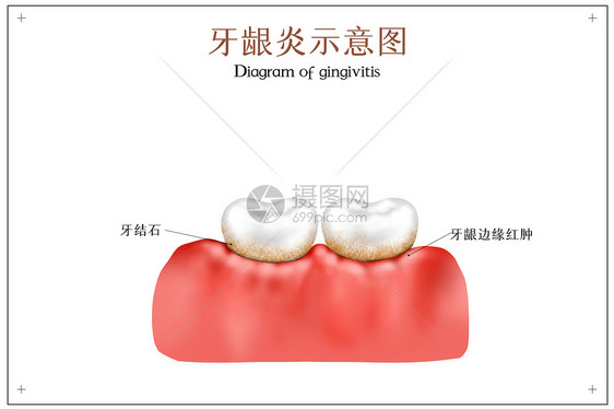 牙龈炎口腔医学配图图片