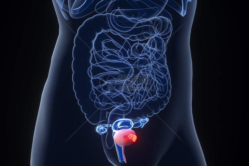 膀胱癌场景图片