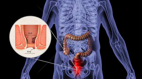 人体痔疮场景图片
