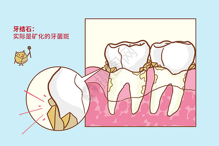 牙结石口腔医学高清图片
