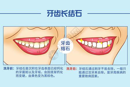 洗牙口腔医学插图背景图片