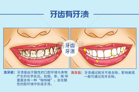 洗牙口腔医学插图图片