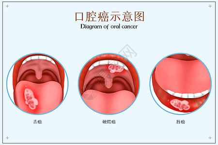 口腔癌医疗配图高清图片