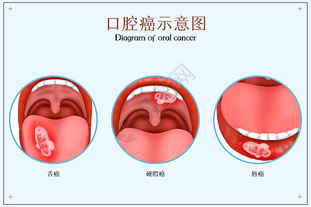 口腔癌医疗配图图片