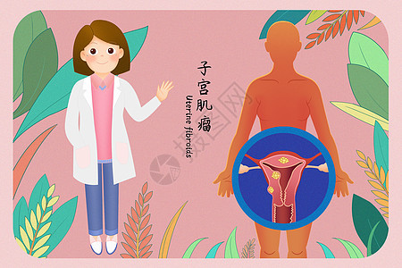 子宫肌瘤医疗插画图片
