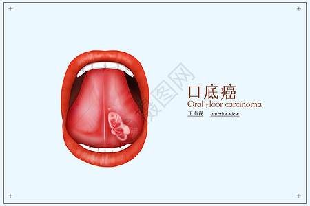 口底癌医疗配图高清图片