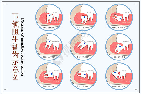 下颌阻生智齿口腔医学配图高清图片