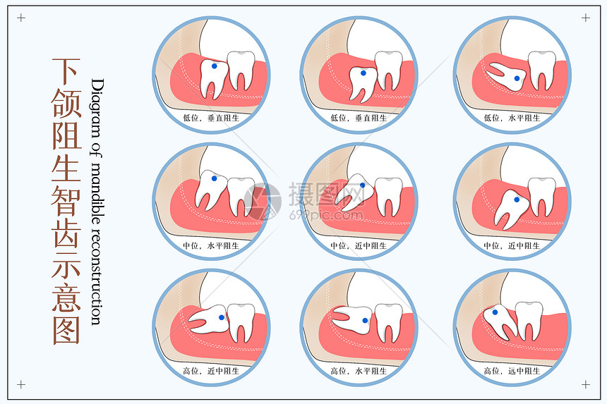 下颌阻生智齿口腔医学配图图片