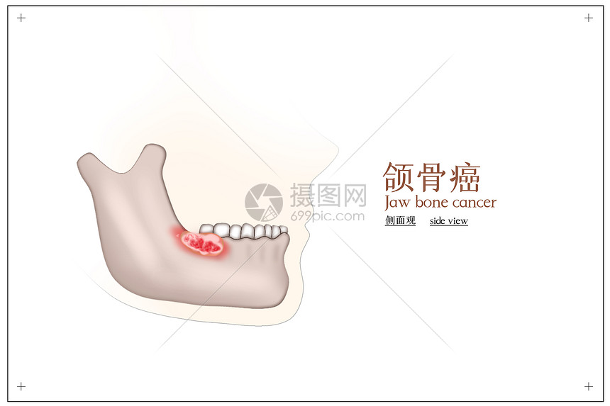 颌骨癌医疗健康配图图片