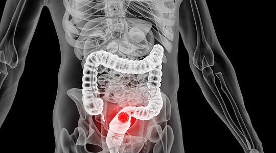 肠道人体肠癌场景设计图片
