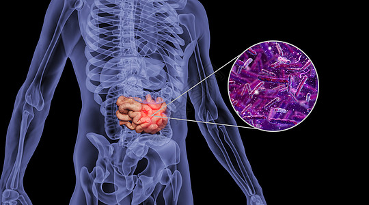 mcn机构人体肠癌场景设计图片