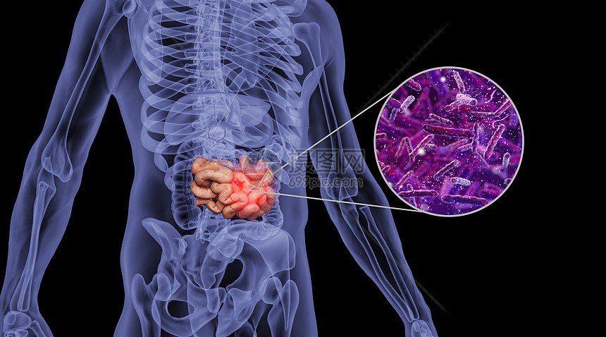 人体肠癌场景图片