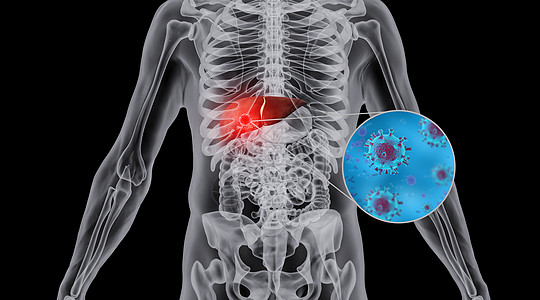 人体肝部肿瘤场景图片