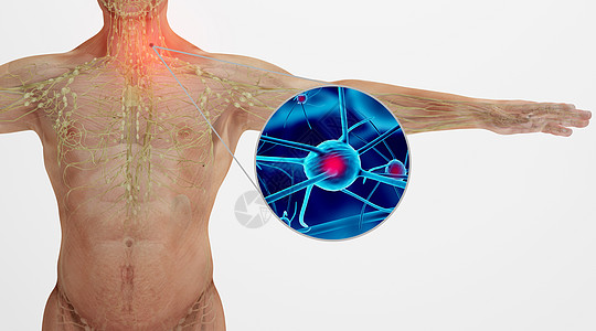 人体淋巴瘤场景高清图片