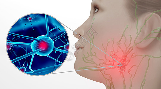 人体淋巴肿大场景设计图片