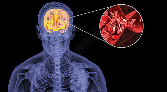 脑血栓人体脑淤血设计图片