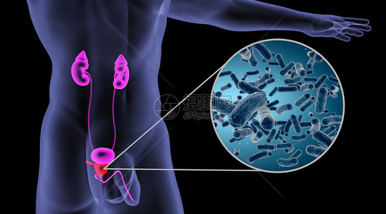 人体前列腺感染场景图片