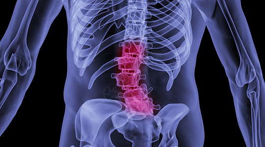 人体组织人体腰椎间盘突出场景设计图片