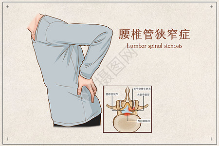 脊椎 管 狭窄 症