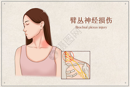 臂丛神经损伤医疗插画图片