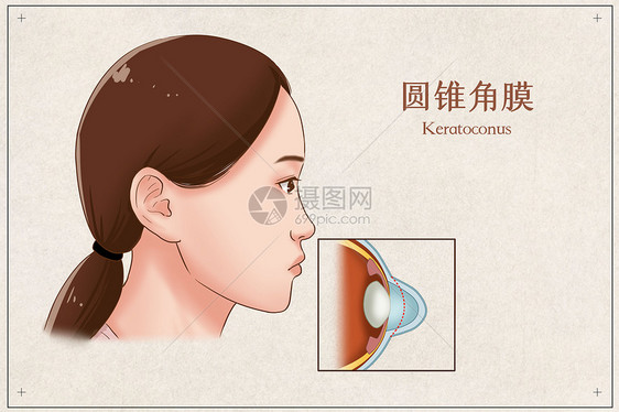 圆锥角膜医疗插画图片