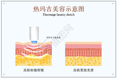 热油锅热玛吉美容紧致肌肤示意图插画