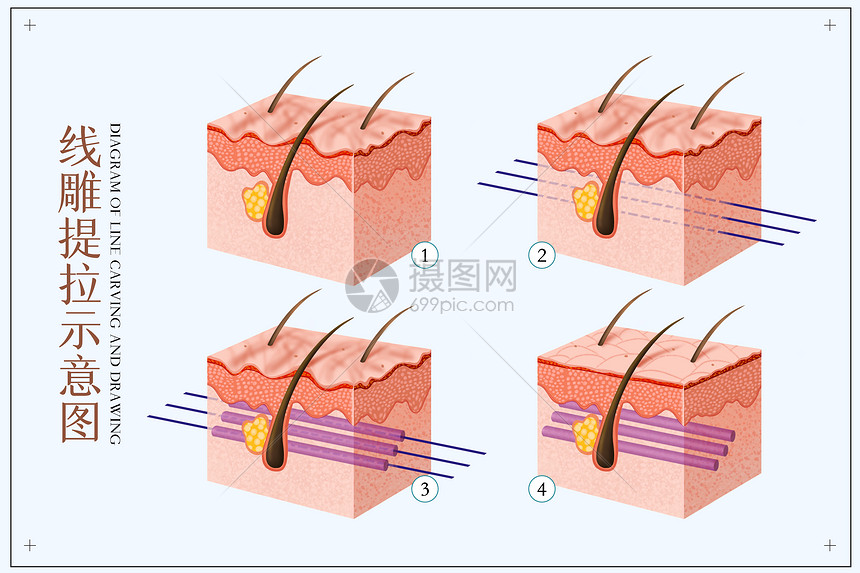 线雕提升面部医美配图图片