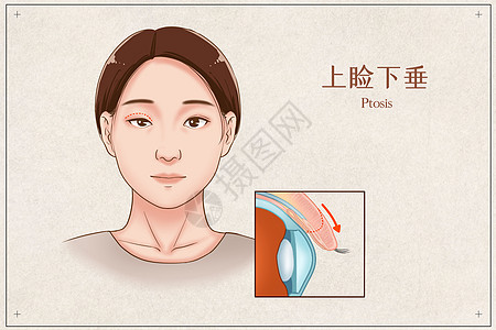 膝盖解剖上睑下垂医疗插画插画