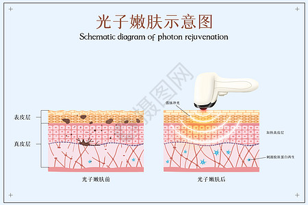 战舰世界光子嫩肤医美配图插画