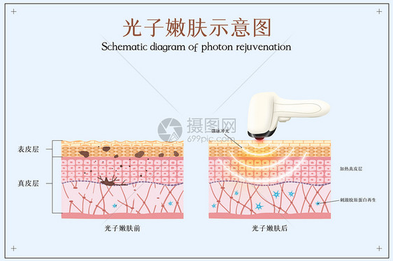光子嫩肤医美配图图片