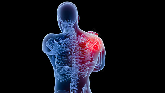关节畸形C4D肩周炎场景设计图片