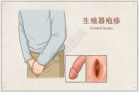 生殖器疱疹医疗插画图片