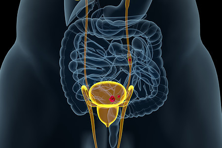 尿路结石背景图片