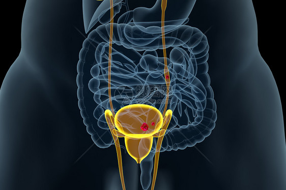 尿路结石图片