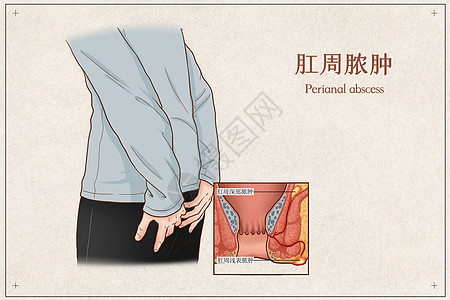 肛窦炎卡通图片