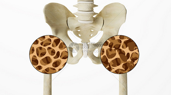 人体骨质疏松场景图片