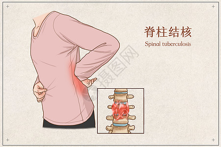 脊柱结核医疗插画高清图片