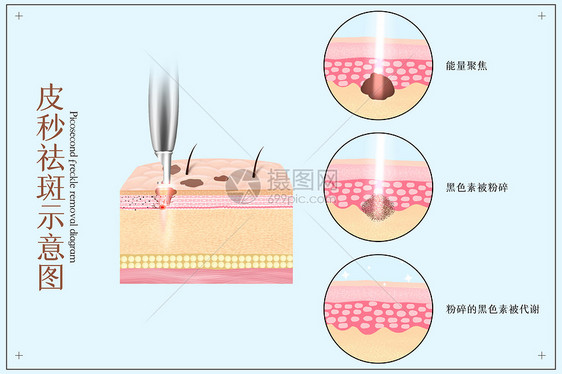 皮秒祛斑医美配图图片