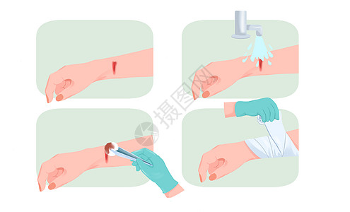 医疗手部受伤处理包扎伤口过程图片