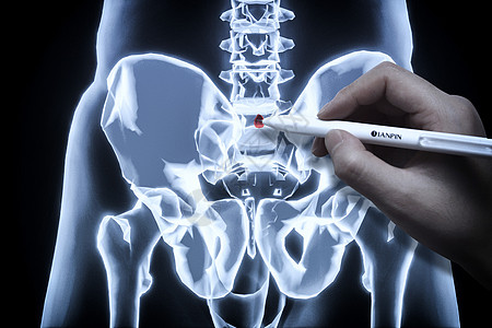 X光盘脊柱伤病设计图片