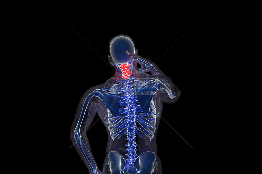 3D人体颈椎病场景图片
