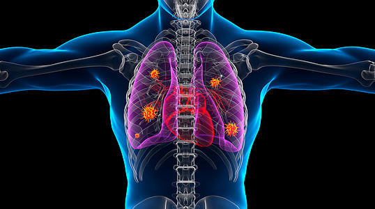 肺部感染人体模型图片